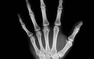 CBD and Bone Health