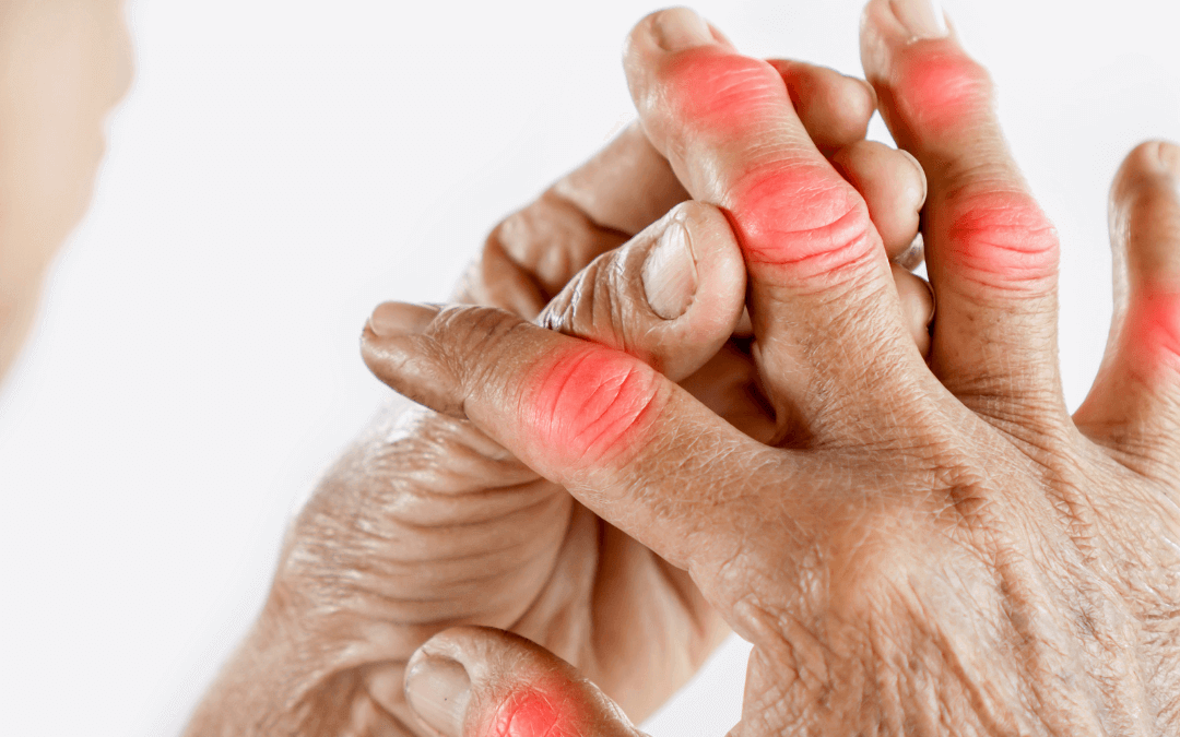 CBD for Inflammation